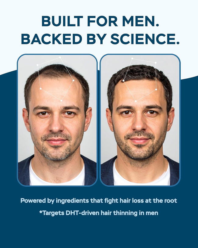 Two portraits of a man side by side comparing hairline density, with a note on DHT